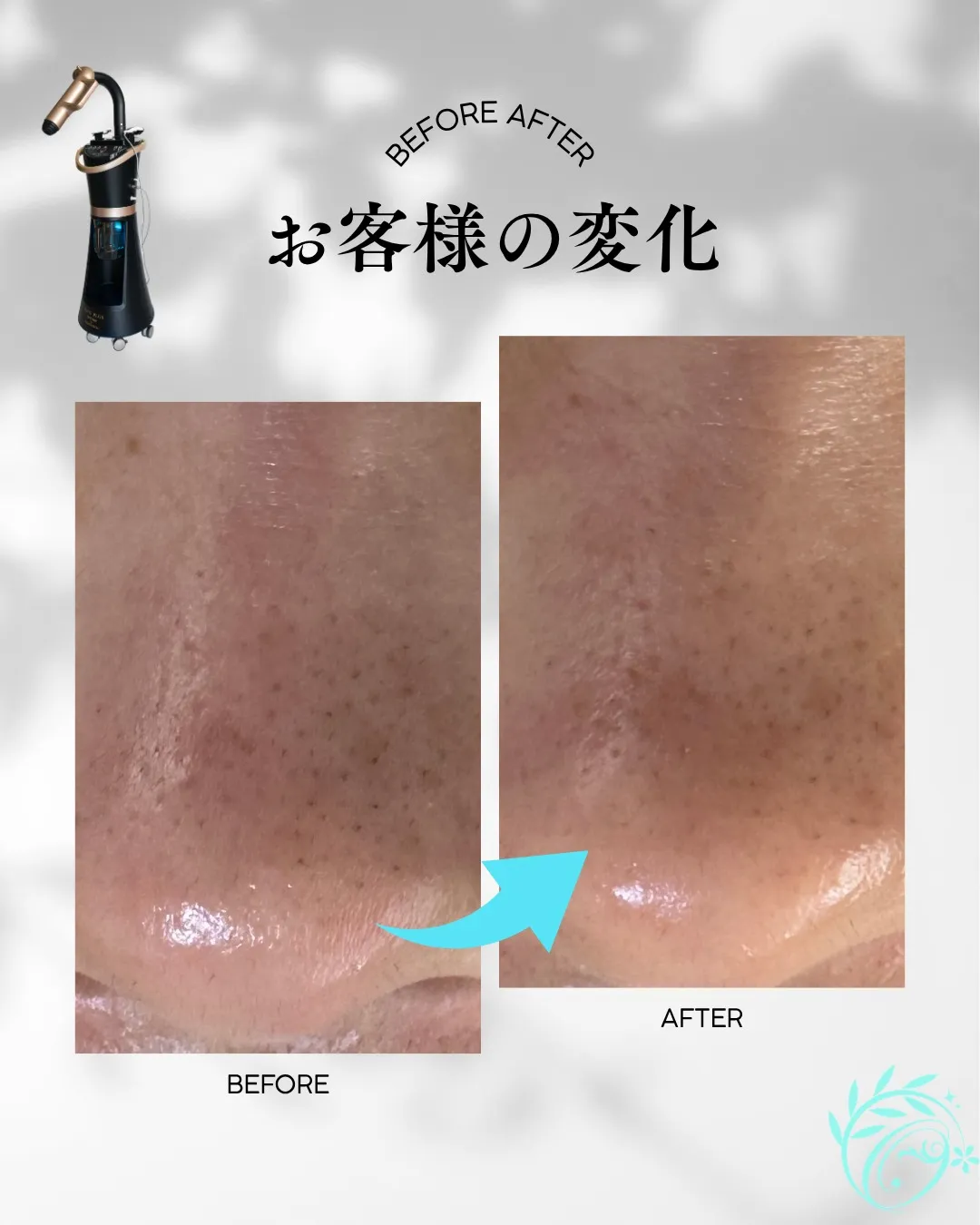 毛穴の黒ずみ・ザラつき、気になっていませんか？🫧【足立区エス...