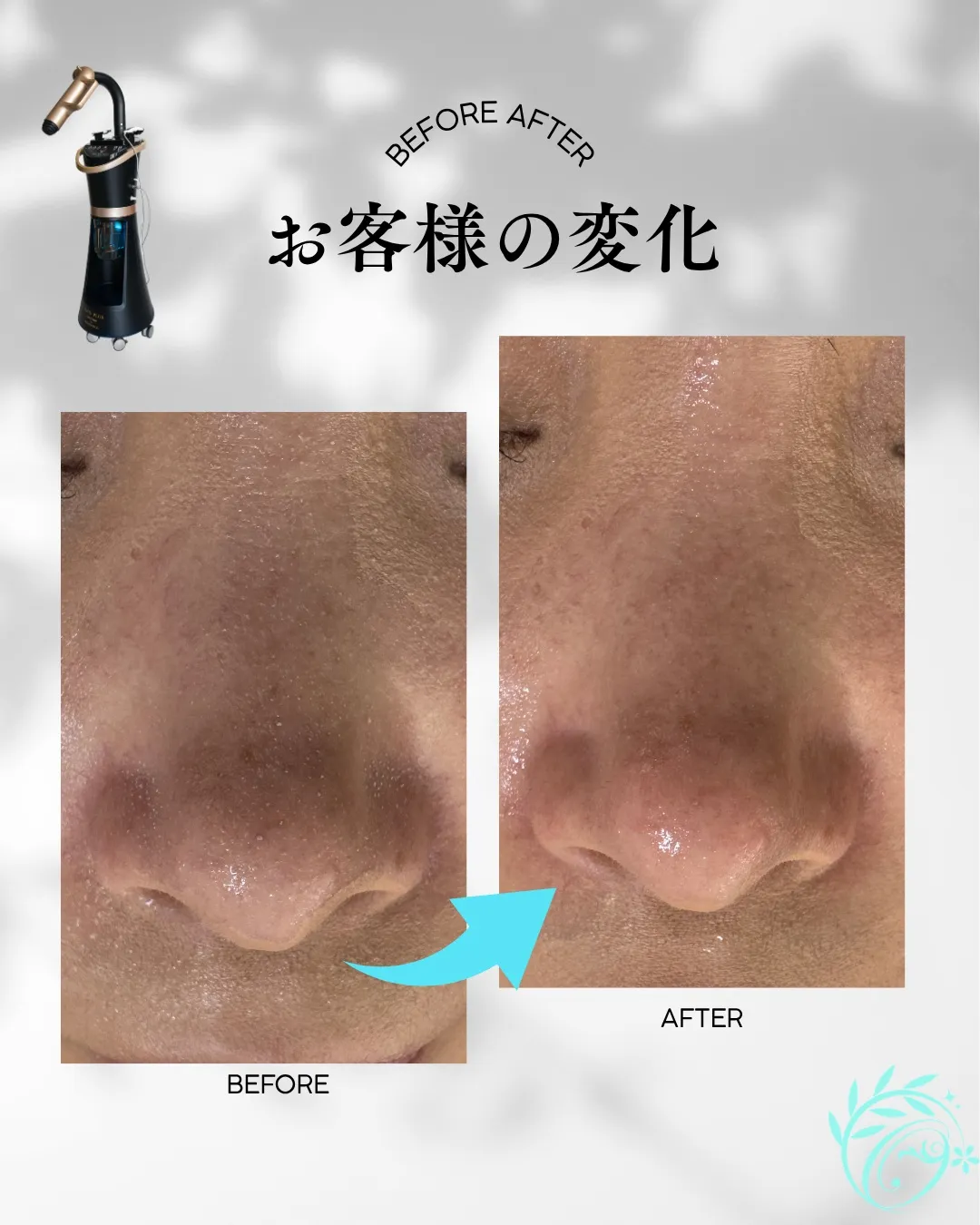 毛穴ケアBeforeAfter【足立区エステ】